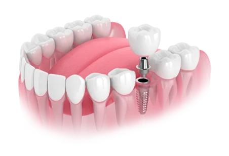 Implants