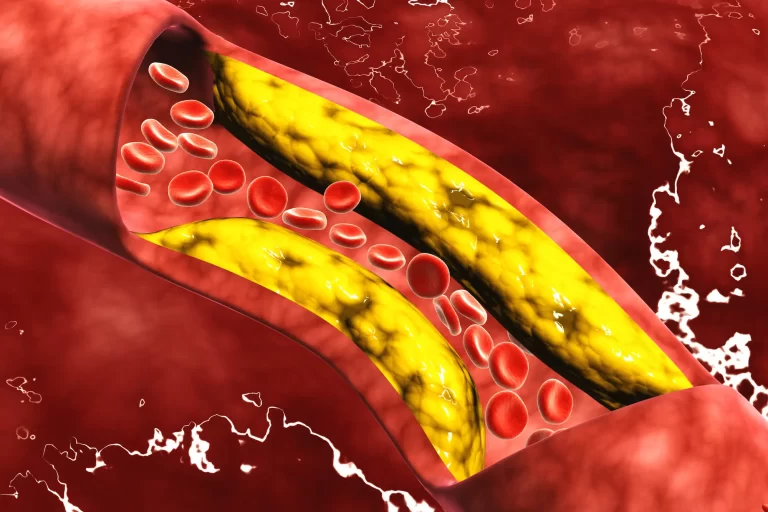 Atherosclerosis