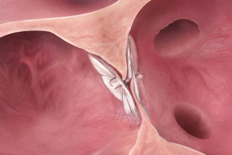 Patent Foramen Ovale (PFO) Closure