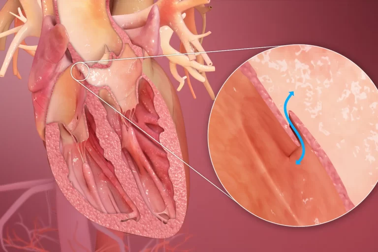Septal Defect Treatment