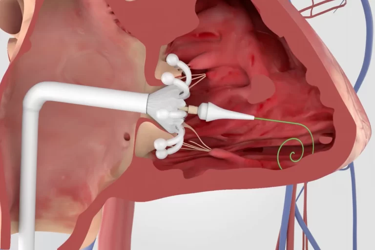 Tricuspid Valve Treatment