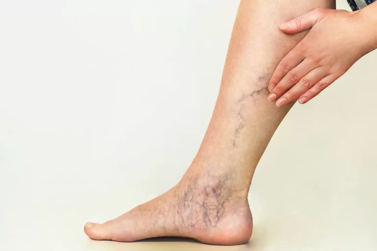 Chronic Venous Insufficiency